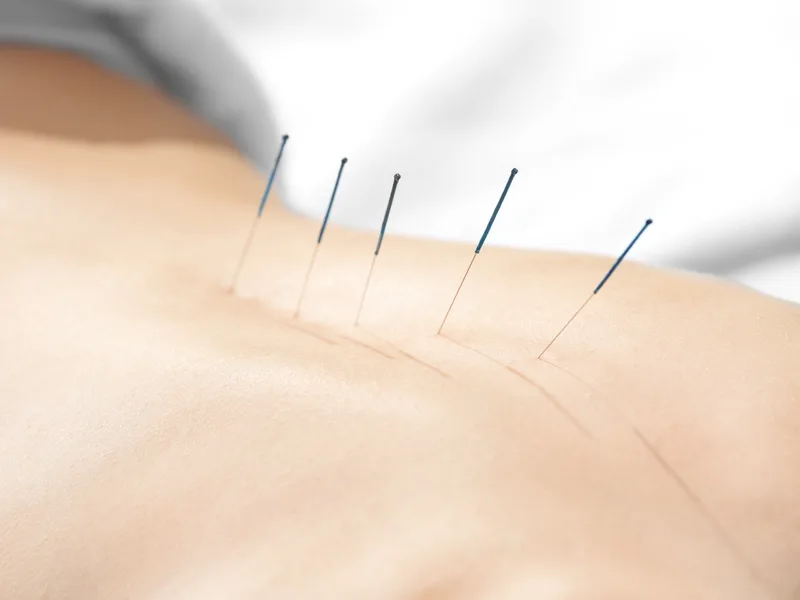 Acupuncture at Locke Chiropractic & Rehabilitation Center in Winston-Salem